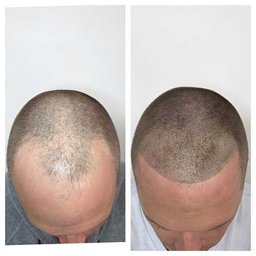 scalp micro pigmentation image