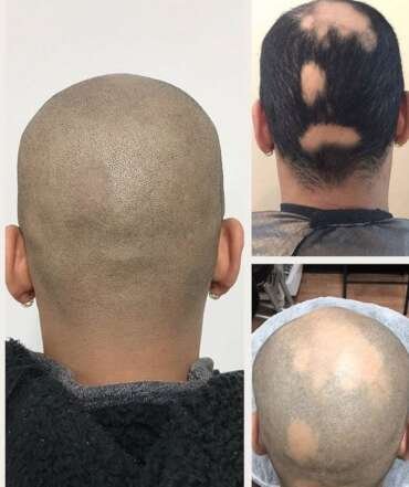 alopecia2 370x441 1