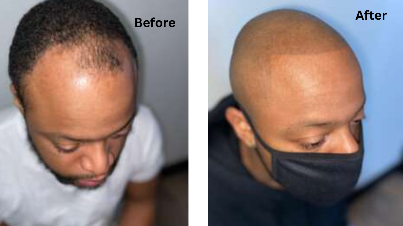 hairline before after