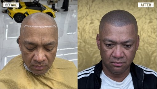 Baldness