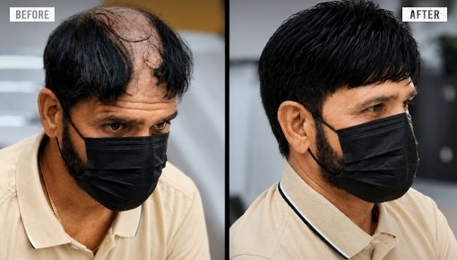 hair replacement 2