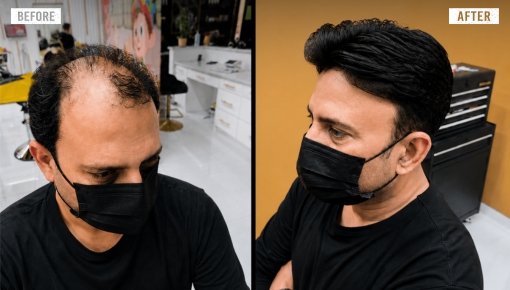 hair replacement 3