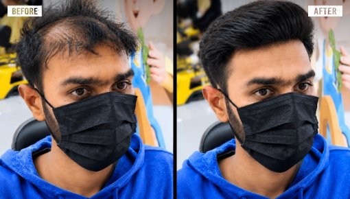 hair replacement